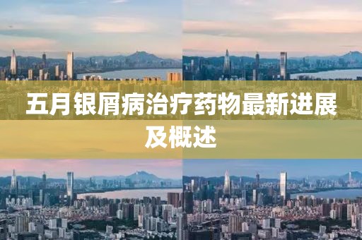 五月银屑病治疗药物最新进展及概述